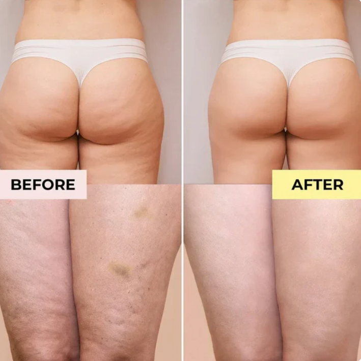 Anti Cellulite Oil